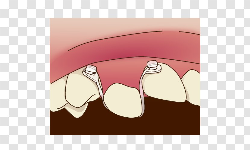 Tooth Dentist 矯正歯科 Dental Braces - Cartoon - Orthodontics Transparent PNG