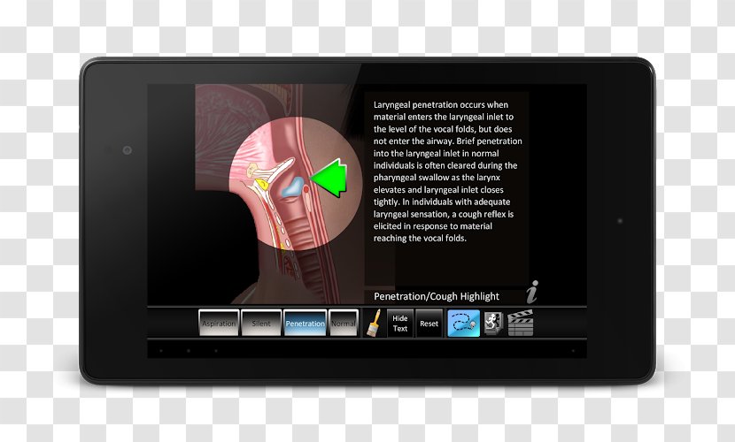 Pulmonary Aspiration Swallowing Pneumonia Medicine Larynx - Heart - Wa Transparan Apk Transparent PNG