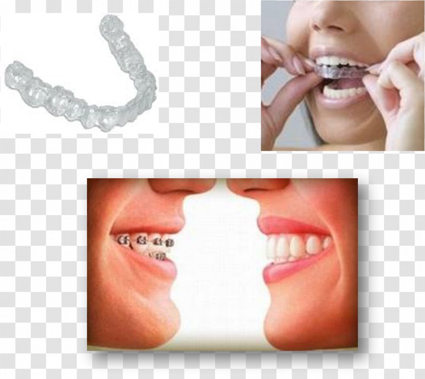 Tooth Dental Braces Orthodontics Crossbite Dentist - Chin - Villa Pavilion Transparent PNG
