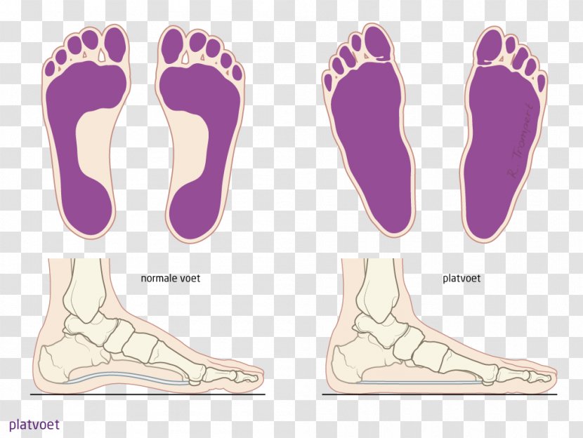 Foot Flat Feet Spreidvoet Patient Knee - Heart - Watercolor Transparent PNG