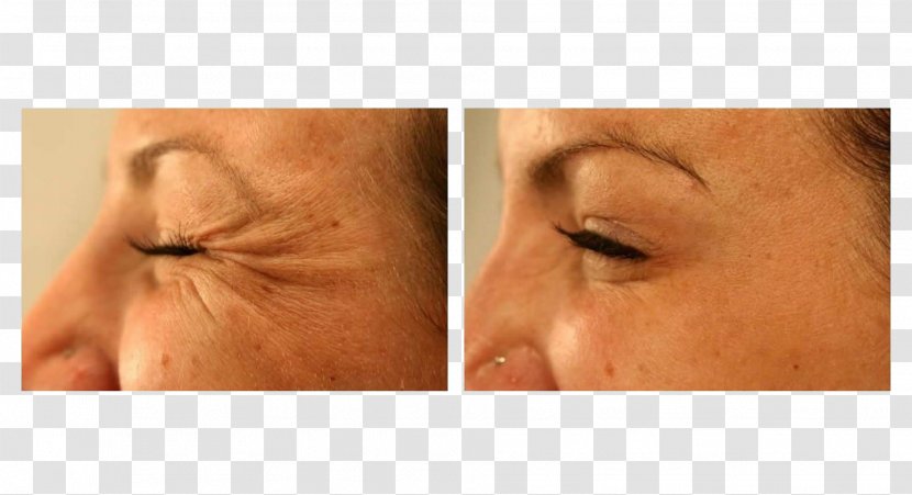 Botulinum Toxin Wrinkle Clostridium Eyebrow Transparent PNG