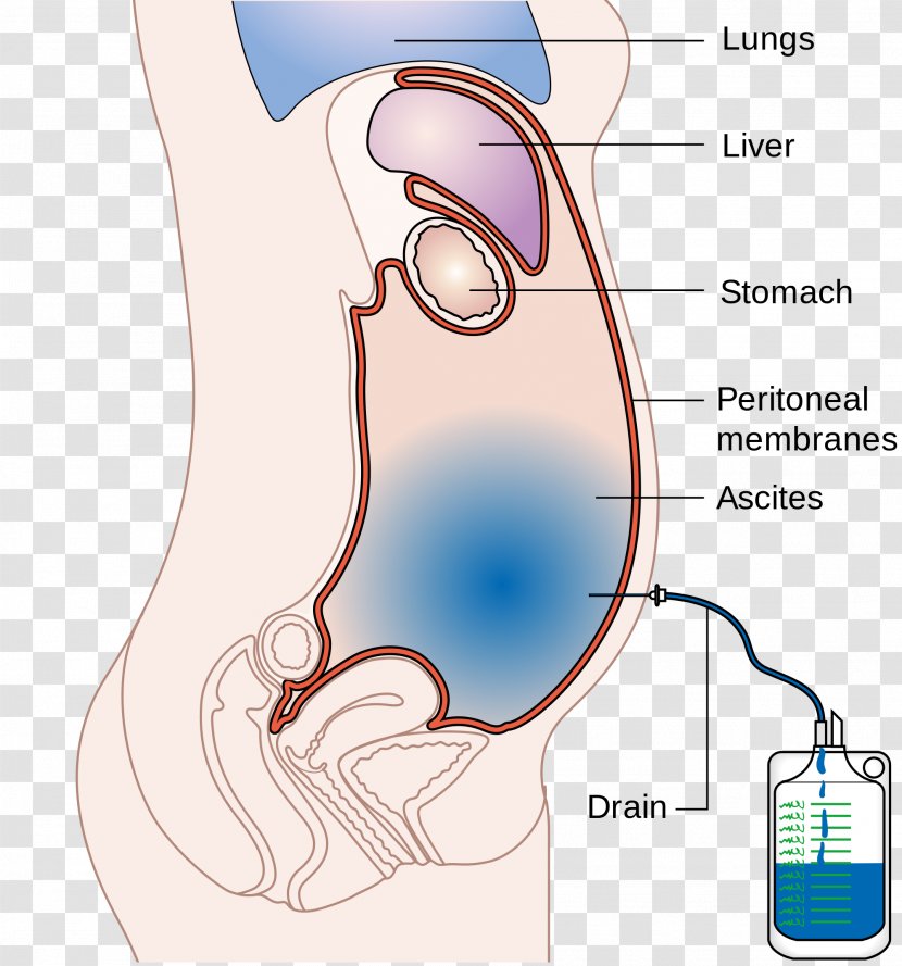 Ascites Paracentesis Abdomen Cirrhosis Peritoneum - Silhouette - Adrenal Gland Transparent PNG