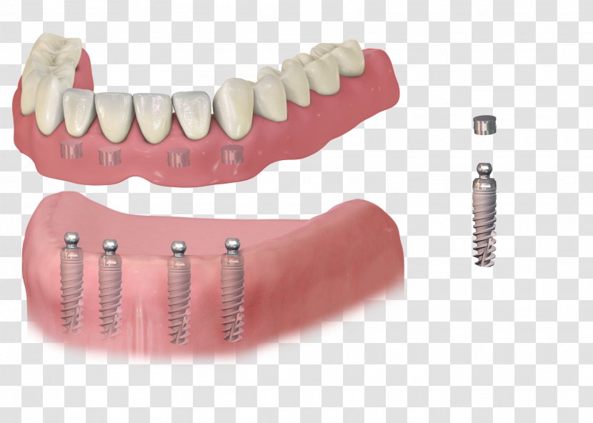 Dental Implant Dentistry Dentures Removable Partial Denture - Bridge Transparent PNG
