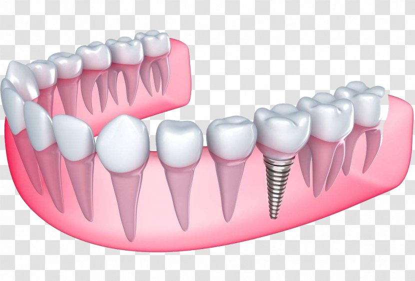 Desert View Dental Implant Dentistry Dentures - Human Tooth Transparent PNG