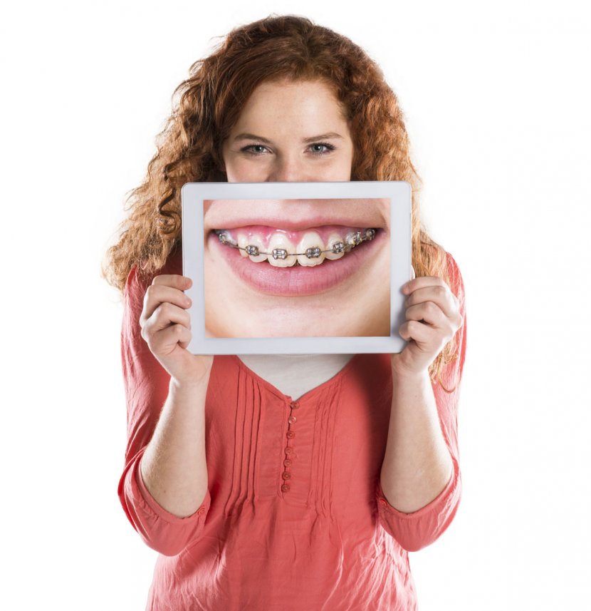 Dental Braces Dentistry Orthodontics Clear Aligners - Tooth - Teeth Transparent PNG