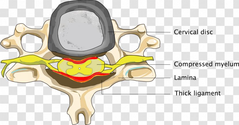 Cervical Spinal Stenosis Neck Cord - Frame - Flower Transparent PNG