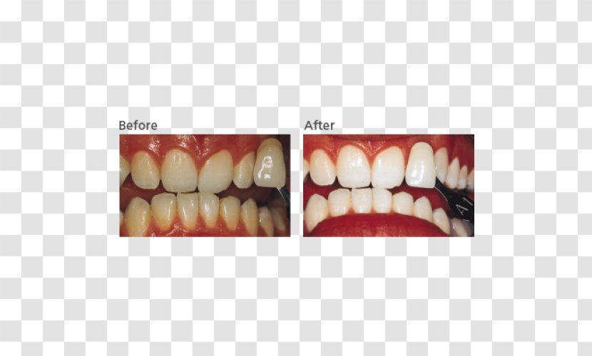 Tooth Whitening Dentistry Hydrogen Peroxide - UreaPola Transparent PNG