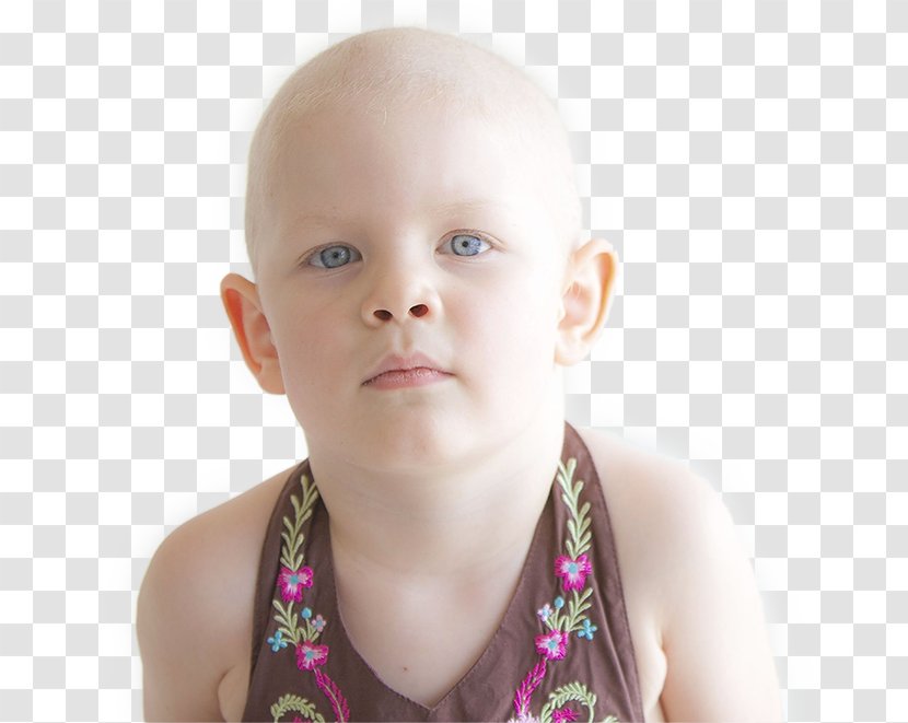 Burkitt's Lymphoma Cancer Therapy Child - Toddler Transparent PNG