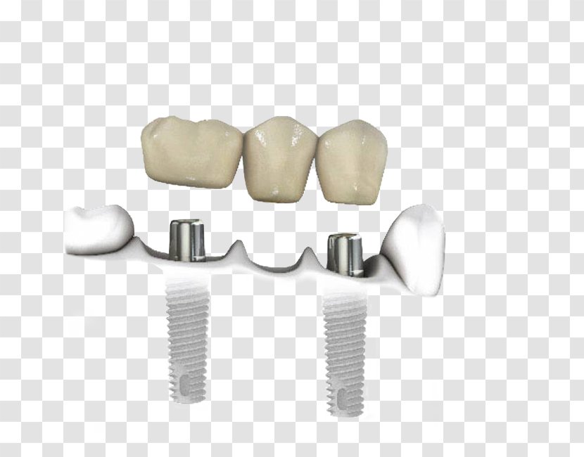 Tooth Dentistry Dental Implant - Biocompatibility - Implants Transparent PNG