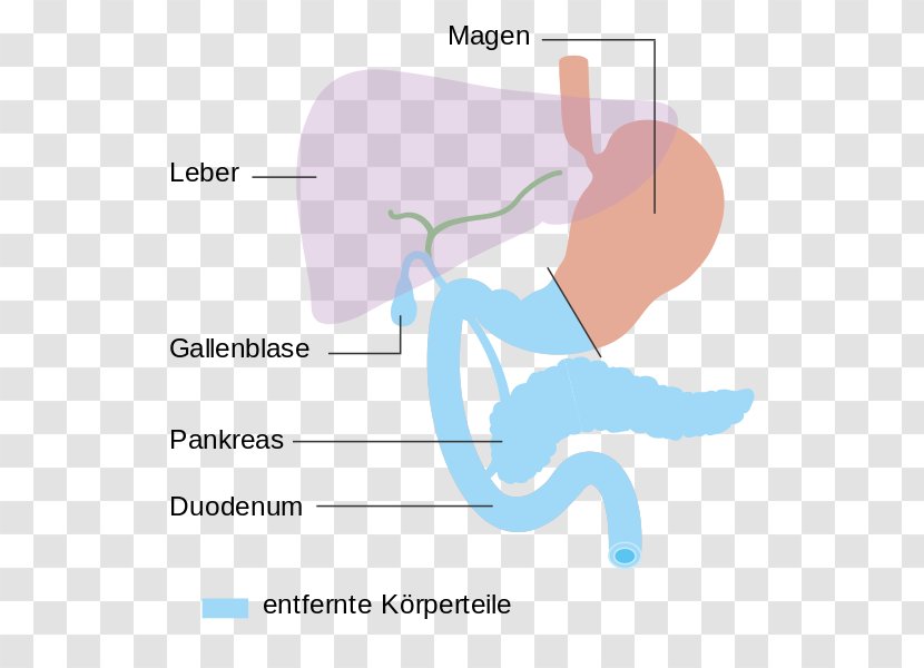 Pancreaticoduodenectomy Pancreatic Cancer Pancreas Thumb Surgery - Tree - Diagramm Transparent PNG