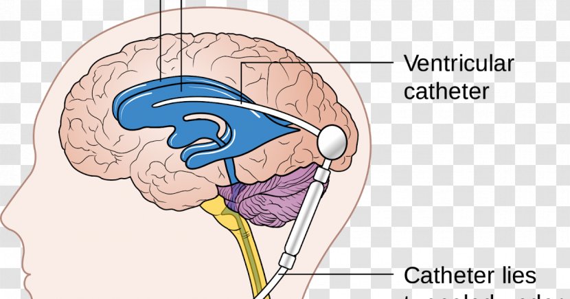 Cerebral Shunt Endoscopic Third Ventriculostomy Hydrocephalus Cerebrospinal Fluid - Watercolor - Heart Transparent PNG