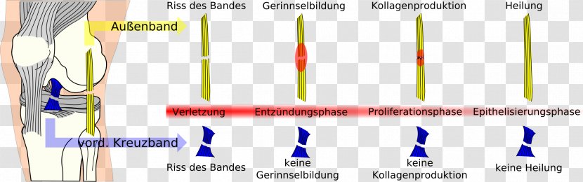 Kecederaan Ligamen Krusiat Hadapan Anterior Cruciate Ligament Ruptur Kollateralligament - Silhouette - Rupture Transparent PNG
