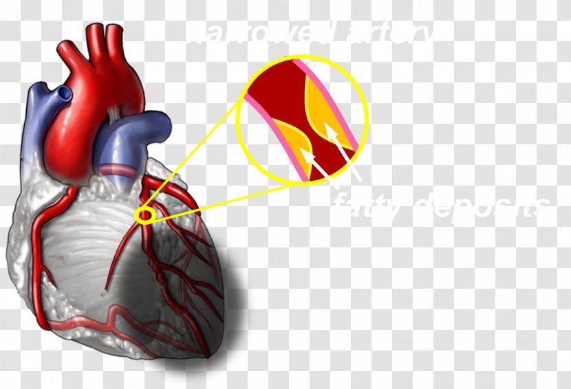 Coronary Artery Disease Heart Cardiovascular Myocardial Infarction Health - Flower - Old Men Attack Transparent PNG