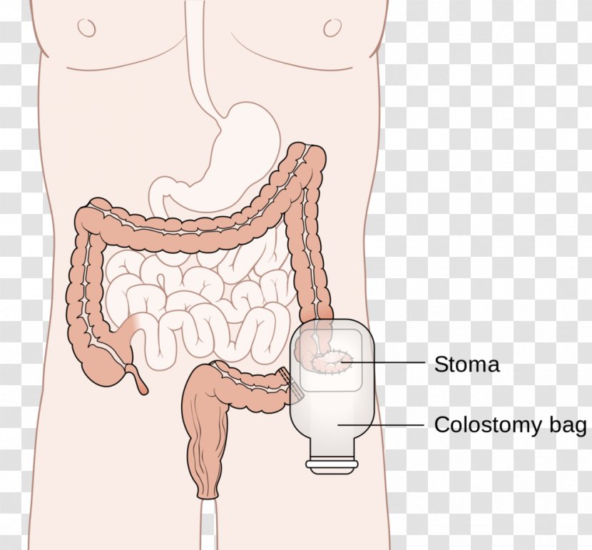 Colostomy Colectomy Surgery Ileostomy Stoma - Heart - 5 X 1000 Transparent PNG