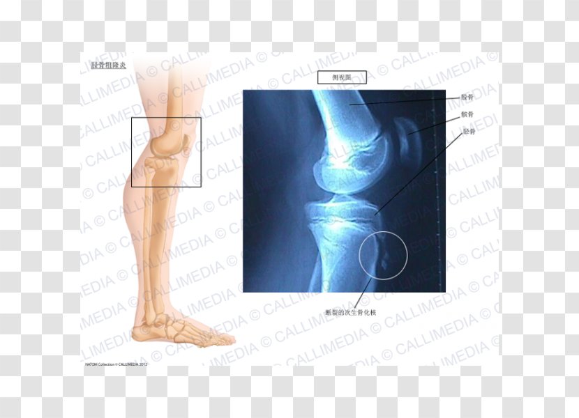 Knee Osgood–Schlatter Disease Ossification Tibia - Flower - Tree Transparent PNG