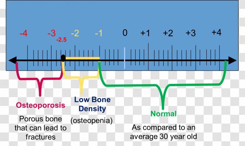 Bone Density Dual-energy X-ray Absorptiometry Osteopenia Densitometry - Text - Test Score Transparent PNG