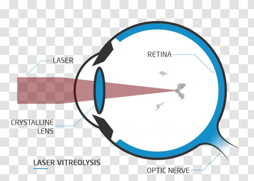 Presbyopia Far-sightedness Floater Eye Visual Perception - Laser Treatment Transparent PNG