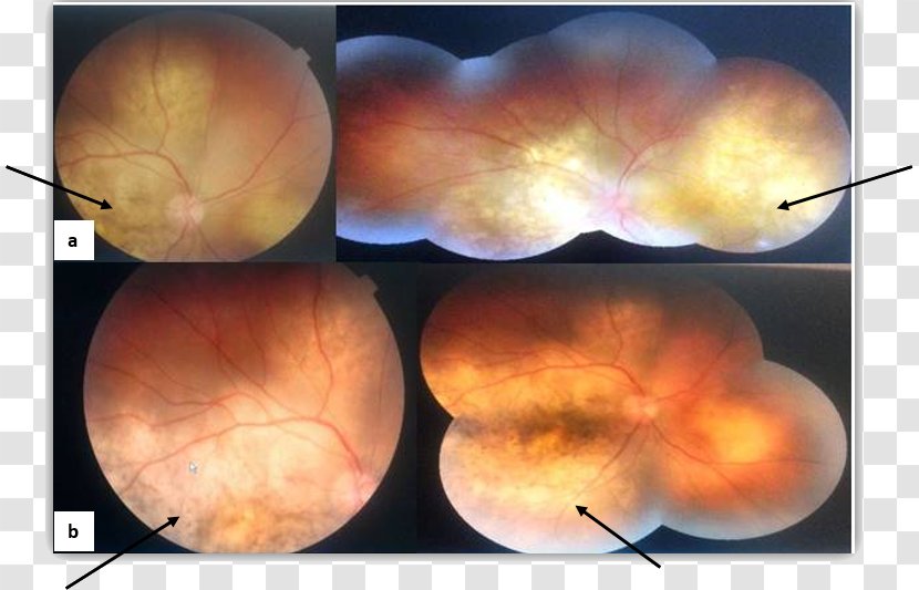 Eye Choroid Metastasis Fundus Extended-spectrum Penicillin - Betalactamase Transparent PNG