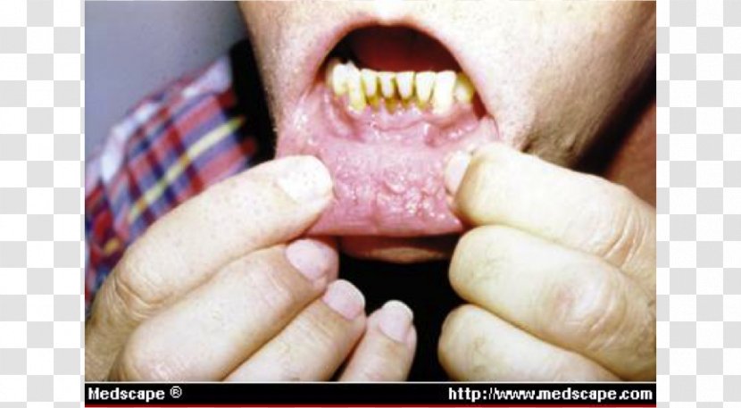 Gums Dipping Tobacco Lip Copenhagen Dentistry - Disease - Pouch Transparent PNG
