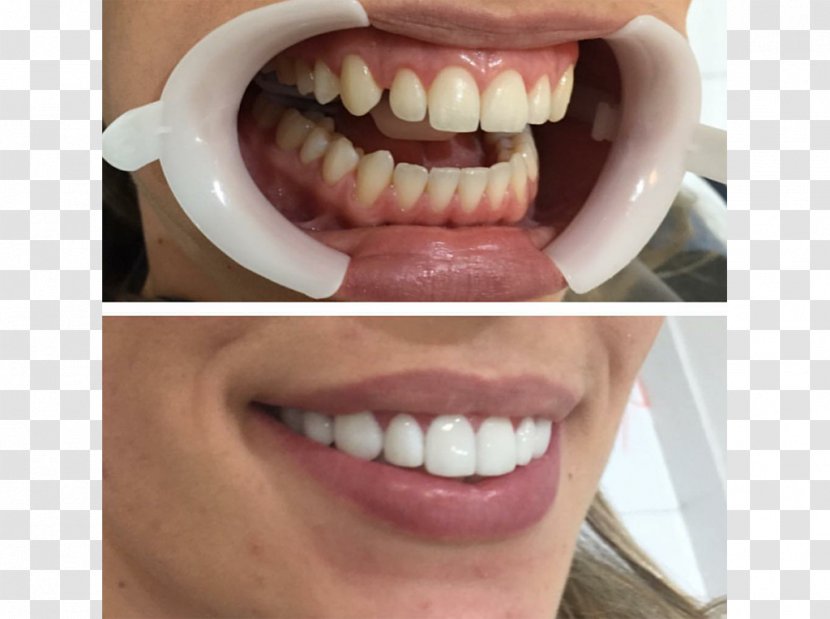 Tooth Whitening Veneer Dentist Dental Implant - Patient - Crown Transparent PNG