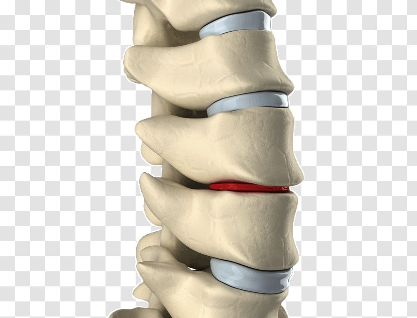 Lumbar Disc Herniation Intervertebral Spinal Decompression Back Pain Vertebral Column - Hand - Disease Prevention Transparent PNG