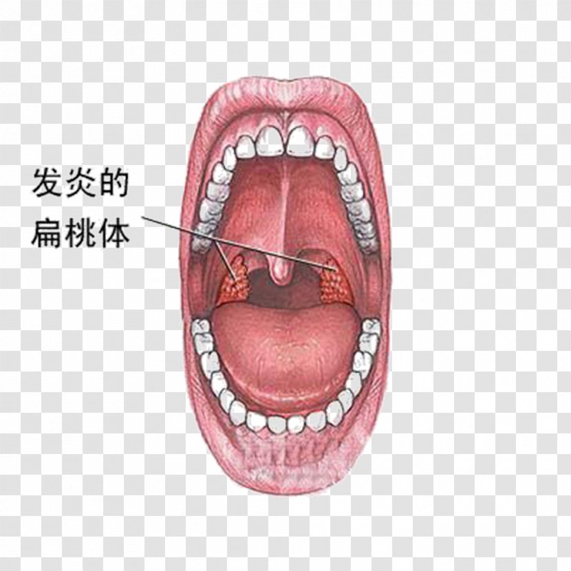 Tonsillitis Inflammation Symptom Disease - Tree - Cancer Lesions Transparent PNG