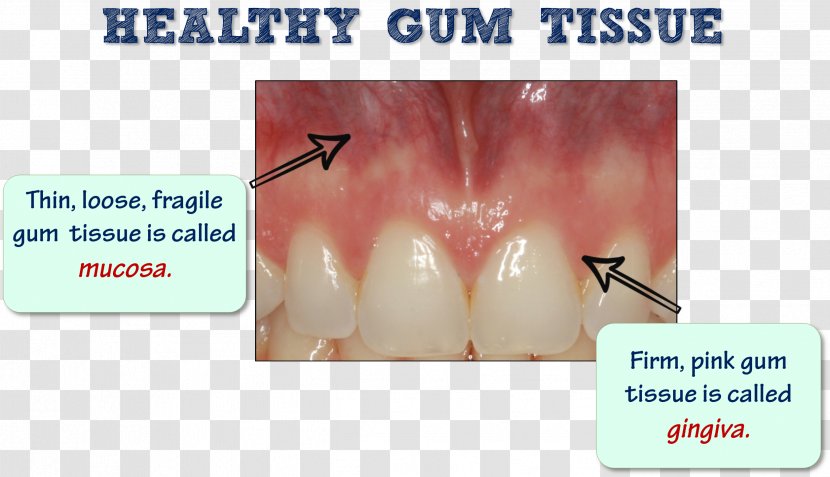 Tooth Periodontal Disease Gums Edentulism Dental Plaque - Cartoon - Frame Transparent PNG