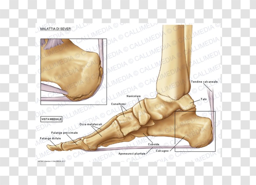 Foot Köhler Disease Bone Osteochondrosis - Tree - Human Body 3D Transparent PNG