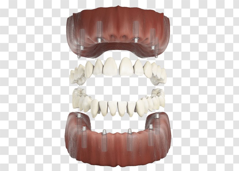 Human Tooth - Implant Transparent PNG