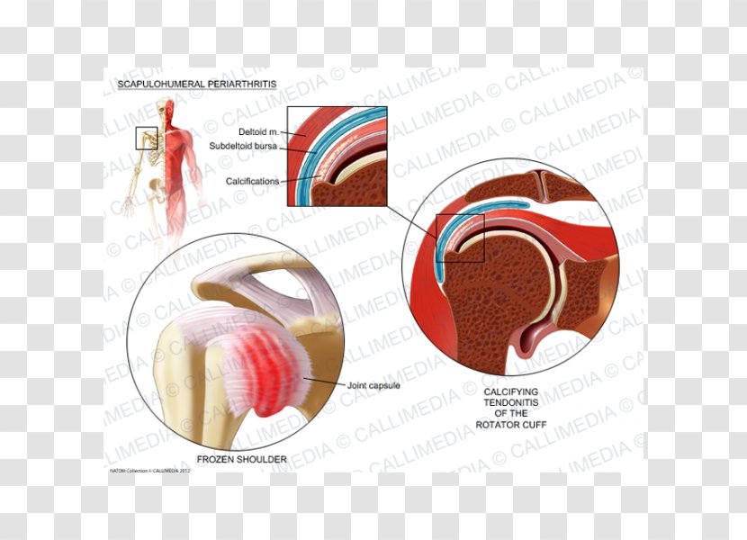 Shoulder Periarthritis Periartrite Scapolo-omerale Rheumatology - Frame - Endocrine System Transparent PNG