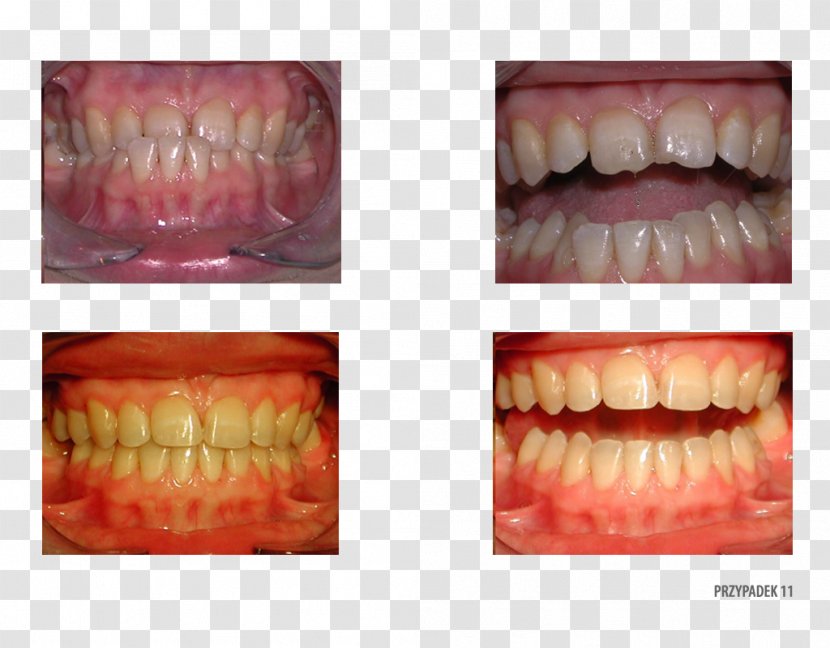 Tooth Dentistry Therapy Orthodontics Clinic - Patient - Cosmetic Transparent PNG