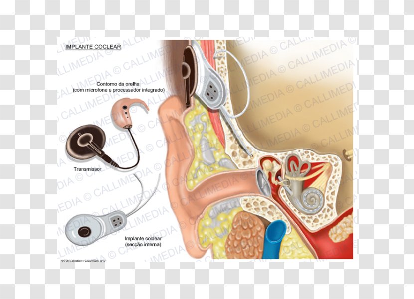 Cochlear Implant Hearing - Tree - Ear Transparent PNG