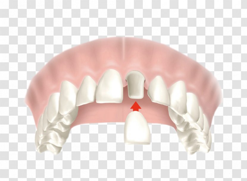 Crown Dentistry Bridge Dental Restoration - Technician - Caries Transparent PNG