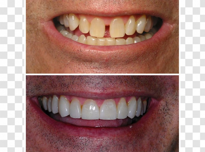 Tooth Veneer All-on-4 Dental Implant Dentistry - Smile - Crown Transparent PNG