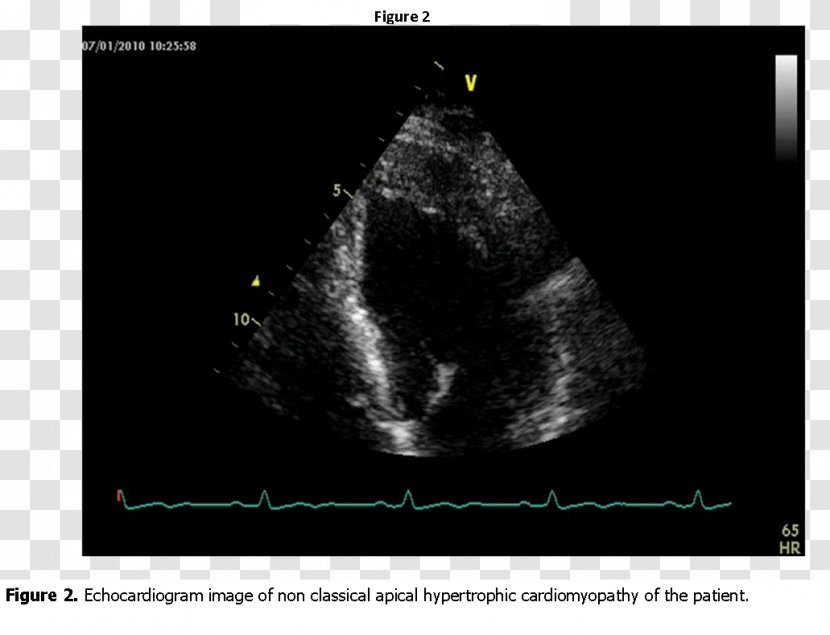 Medical Imaging Radiology Medicine Phenomenon Font - Hypertrophic Cardiomyopathy Transparent PNG