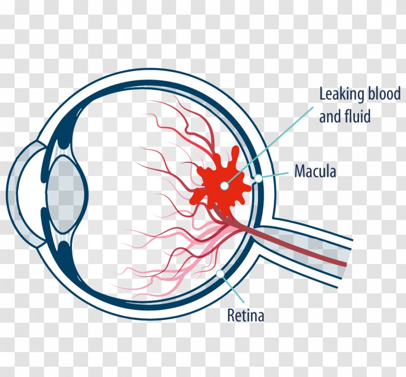 Macula Of Retina Macular Edema Diabetic Retinopathy Eye - Silhouette Transparent PNG