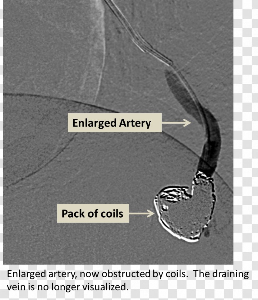 Cerebral Arteriovenous Malformation Lung Malformacja Embolization - Flower - Watercolor Transparent PNG