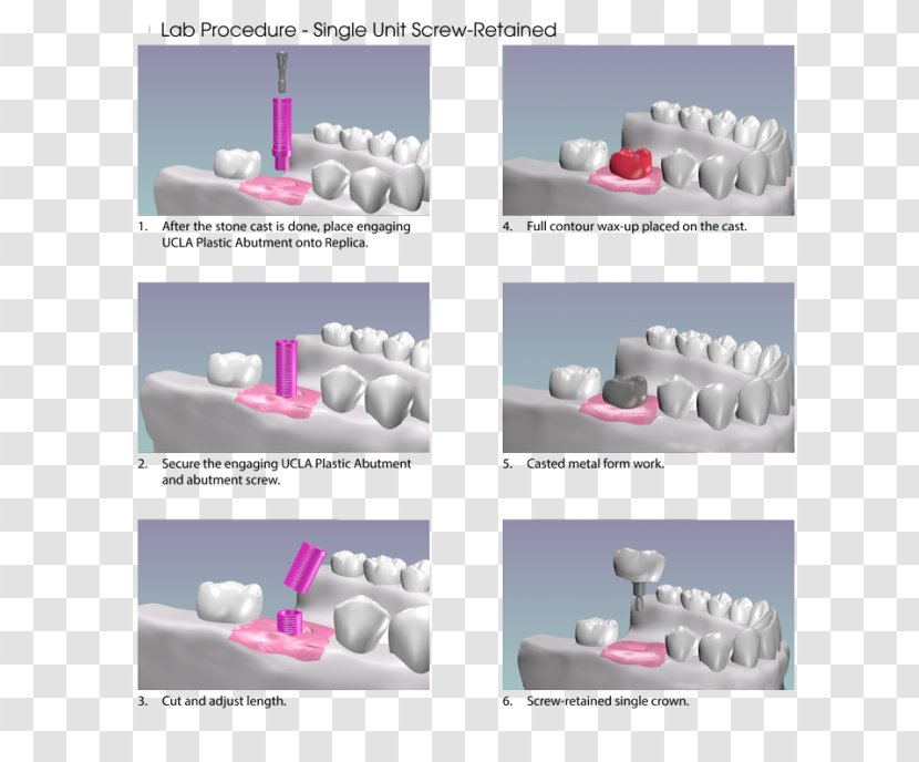 Abutment Dental Implant Dentistry - Shoe - Implants Transparent PNG