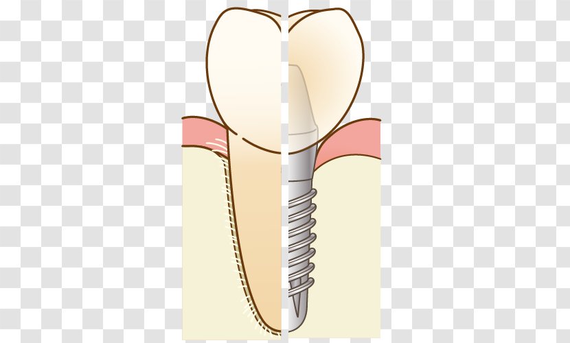 Dentist 歯科 Dental Implant Therapy Dentures - Heart - Bridge Transparent PNG