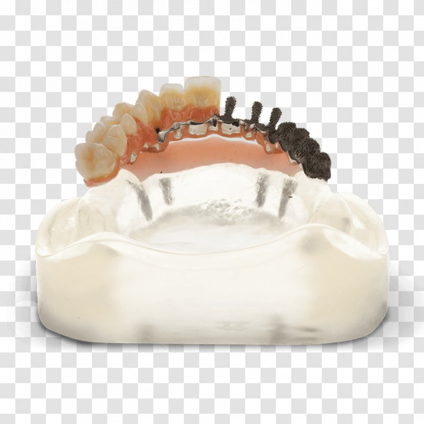 Tooth Dentistry Bridge Dentures Dental Implant - Surgery - 3d Repair Transparent PNG