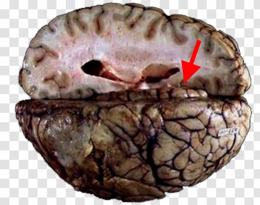 Brain Herniation Cerebellar Tentorium Tentorial Incisure Uncus Cingulate Gyrus Transparent PNG