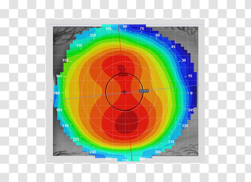Corneal Topography Keratoconus Contact Lenses Optometry - Intraocular Lens - Eye Transparent PNG