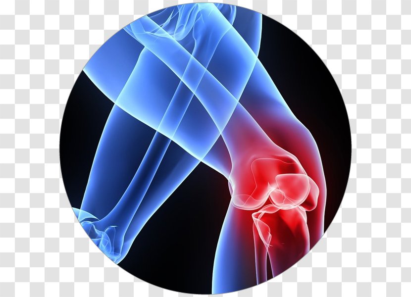 Patellar Tendinitis Tendinopathy Knee Pain - Artrosis De Rodilla Transparent PNG
