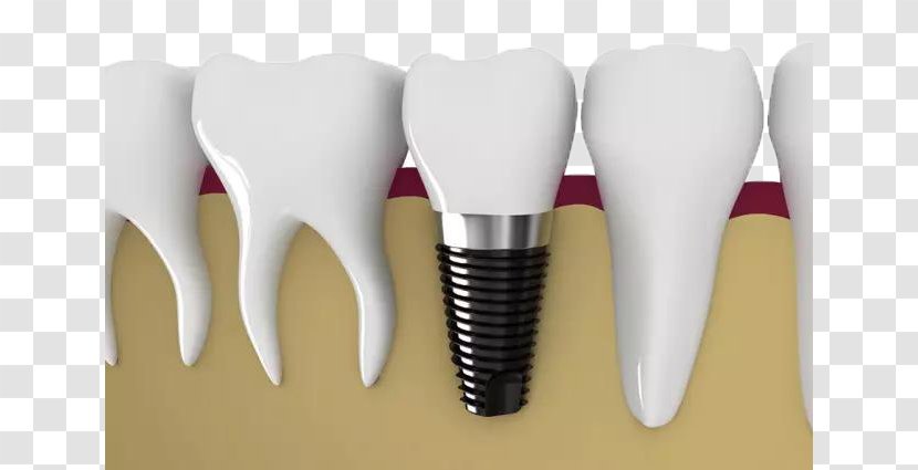 Dental Implant Dentistry Tooth Veneer Restoration - Watercolor - White Teeth Material Transparent PNG