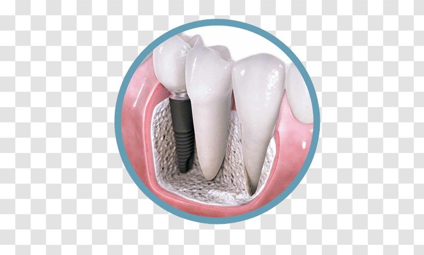 Dental Implant Dentistry Surgery - Tooth - Crown Transparent PNG