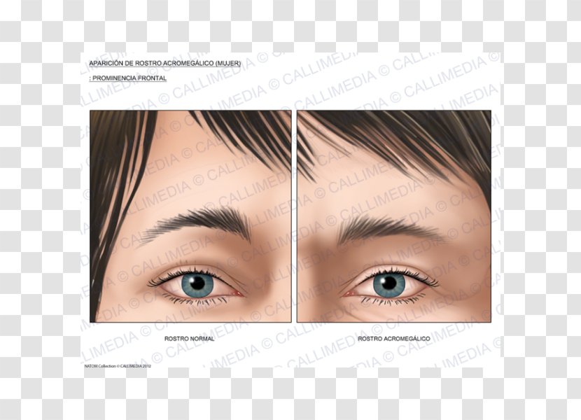 Skull Bossing Acromegaly Growth Hormone Symptom Forehead - Eyelash - Face Transparent PNG