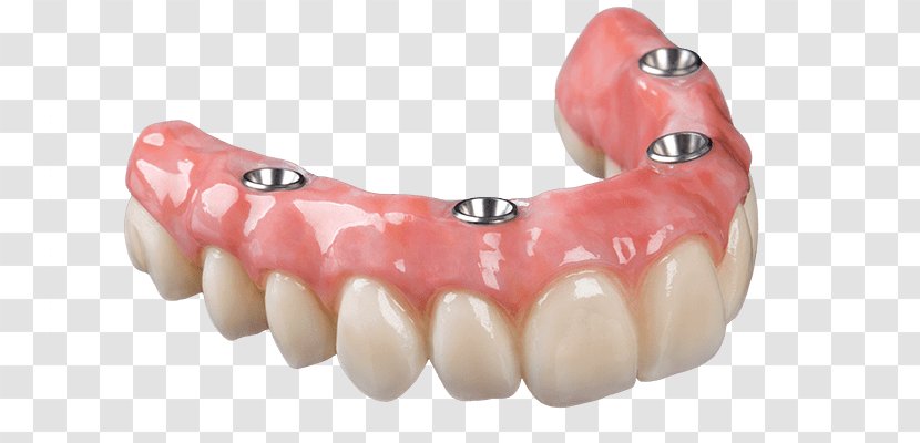 Dental Implant Dentures Removable Partial Denture Prosthesis Dentistry - Bridge Transparent PNG