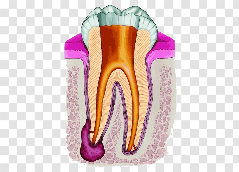 Endodontic Therapy Root Canal Endodontics Dentistry - Cartoon - Crown Transparent PNG