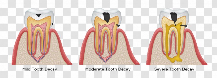 Tooth Decay Human Dentistry Dental Restoration - Silhouette - Caries Transparent PNG