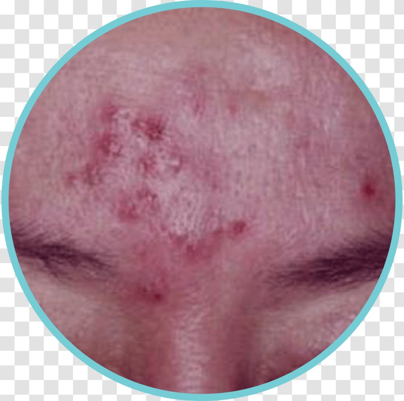 Disease Acne Scar After Image 1 Therapy - Watercolor Transparent PNG